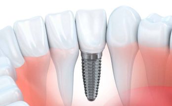 Dental Implants