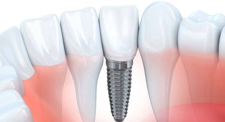 Dental Implants