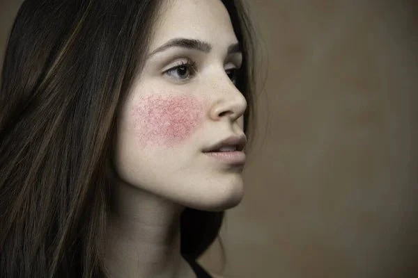 Rosacea