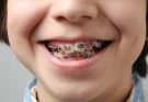 Braces for Kids in Burtonsville, MD: What Parents Need to Know About Orthodontics Early On