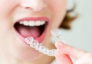 How Living with Invisalign Impacts Your Daily Routines