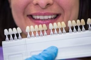 The Veneers Process, Step by Step