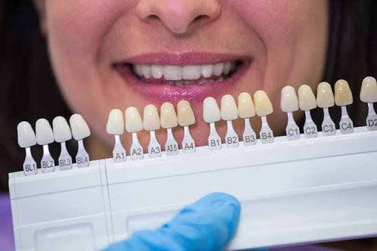 The Veneers Process, Step by Step