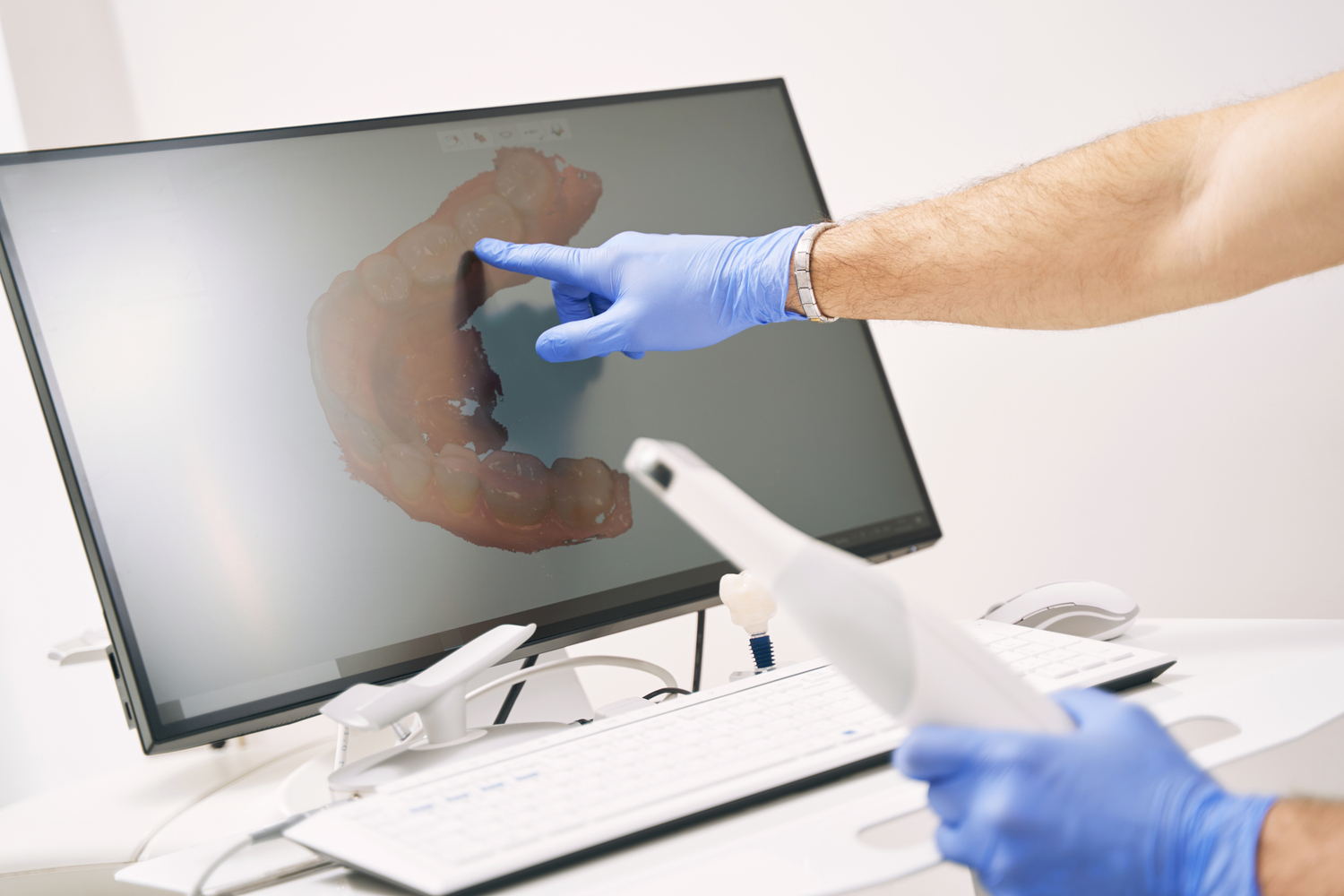 dental implants